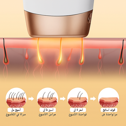جهاز إزالة الشعر بالليزر IPL مع تبريد بالثلج