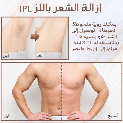 جهاز إزالة الشعر بالليزر IPL مع تبريد بالثلج